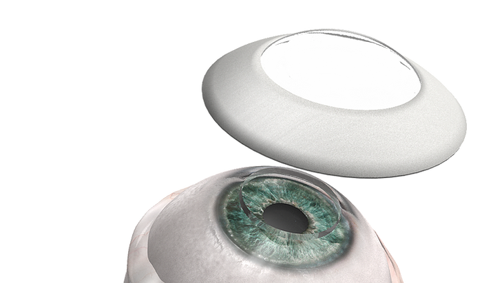 👁 Blind man fick synen tillbaka med en artificiell hornhinna