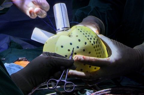 ❤️ Robothjärta räddar livet på hjärtsjuk