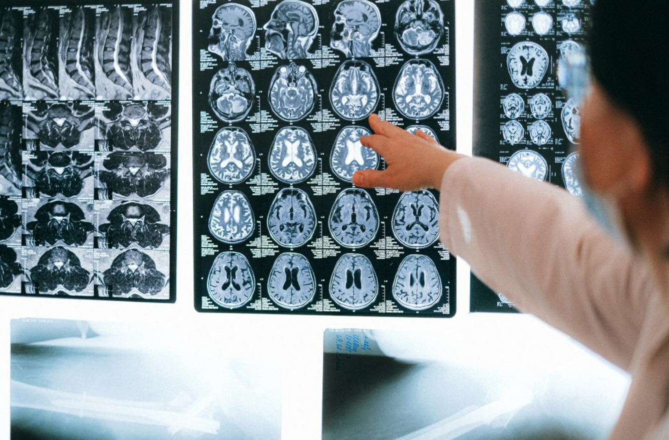 🧠 AI kan diagnosticera Alzheimers med över 99 procents säkerhet