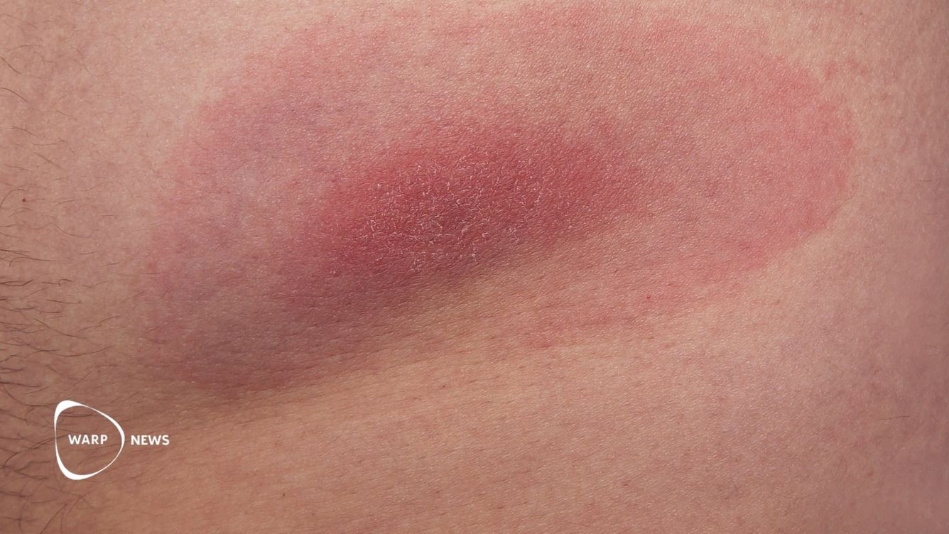 💉 Nytt vaccin minskade fall av borrelia med 70 procent i studie