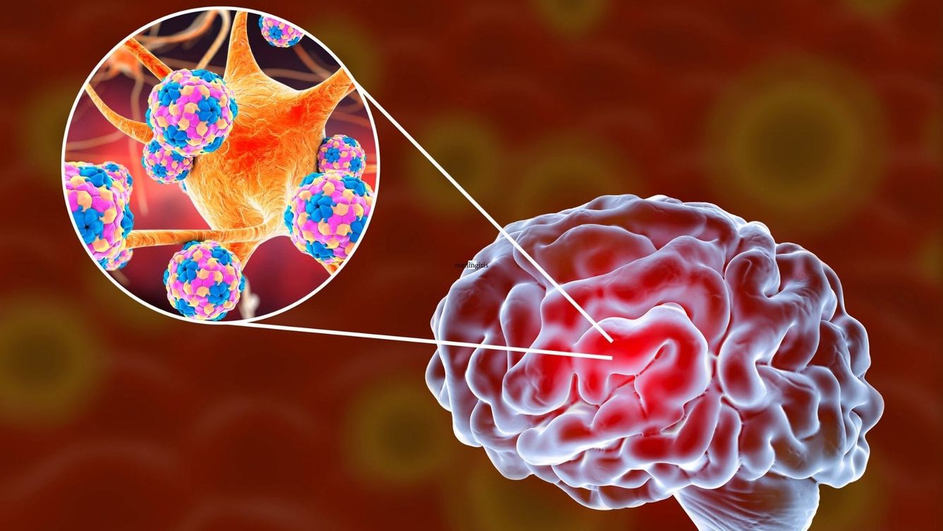 🧠 Dödsfallen i hjärnhinneinflammation bland små barn har minskat med två tredjedelar sedan 1990