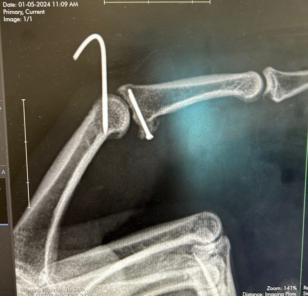 Six Broken Bones Later: What Injury Actually Teaches You