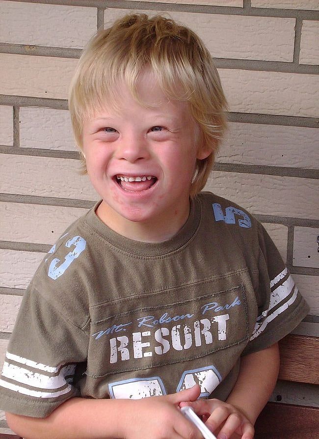 How To Get Rid of Down Syndrome