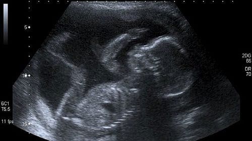 Why A Pro-Abortion Rhode Island State Senator Killed An All-Nine-Months Abortion Bill