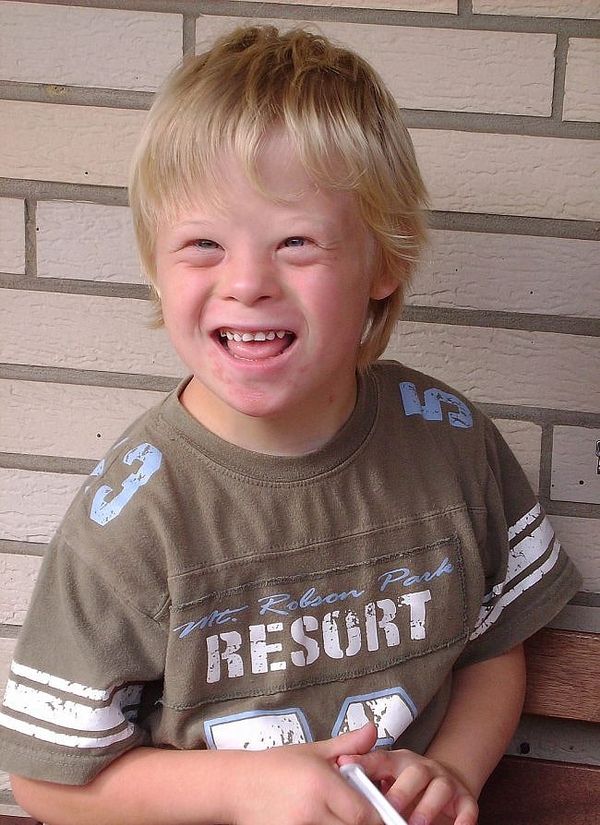 How To Get Rid of Down Syndrome