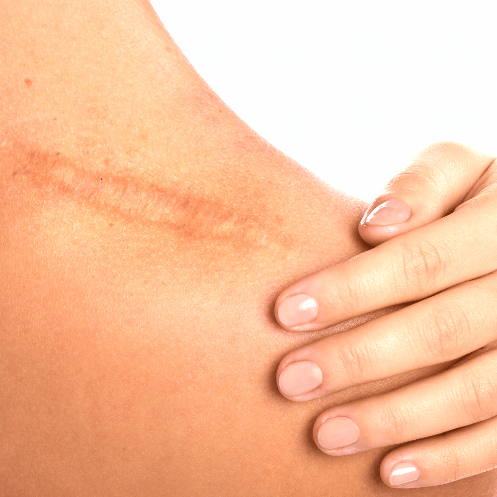 best scar tissue massage tool