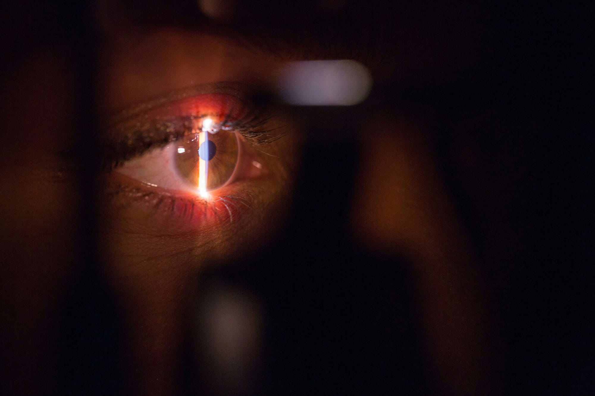 Role of Biophotometers in AMD Diagnosis