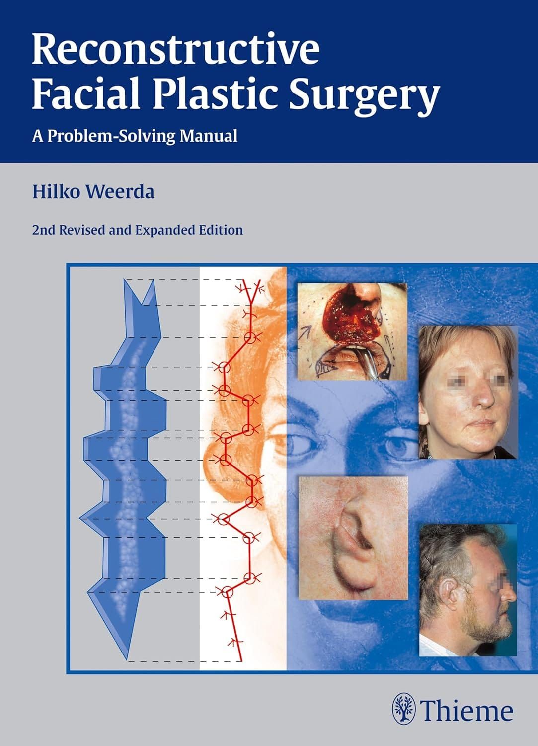 Reconstructive Facial Plastic Surgery A Problem-Solving Manual 2nd Revised and Expanded Edition By Hilko Weerda