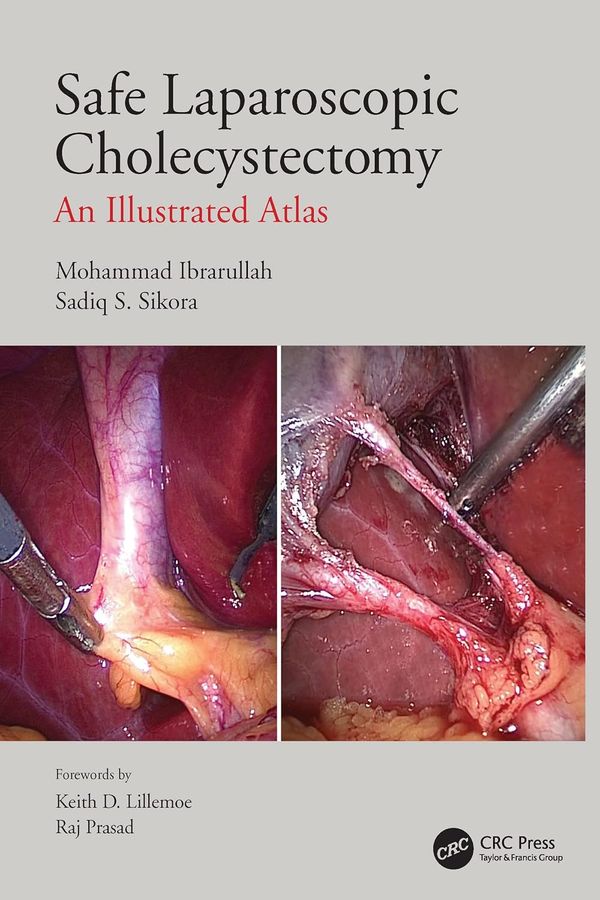 Safe Laparoscopic Cholecystectomy An Illustrated Atlas 1st Edition By Mohammad Ibrarullah, Sadiq Sikora