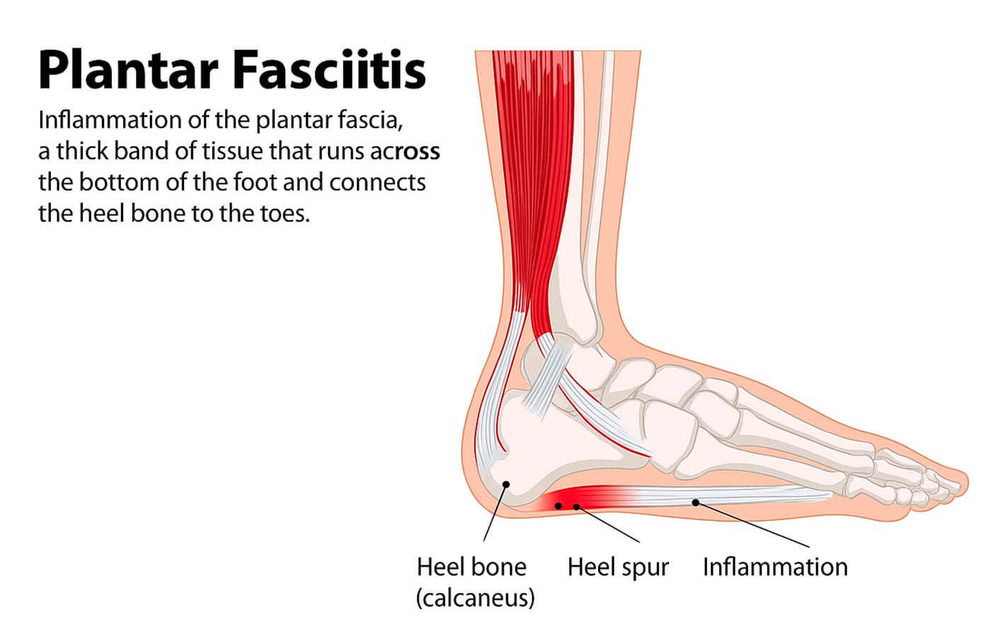 Plantar Fasciitis Illustrated