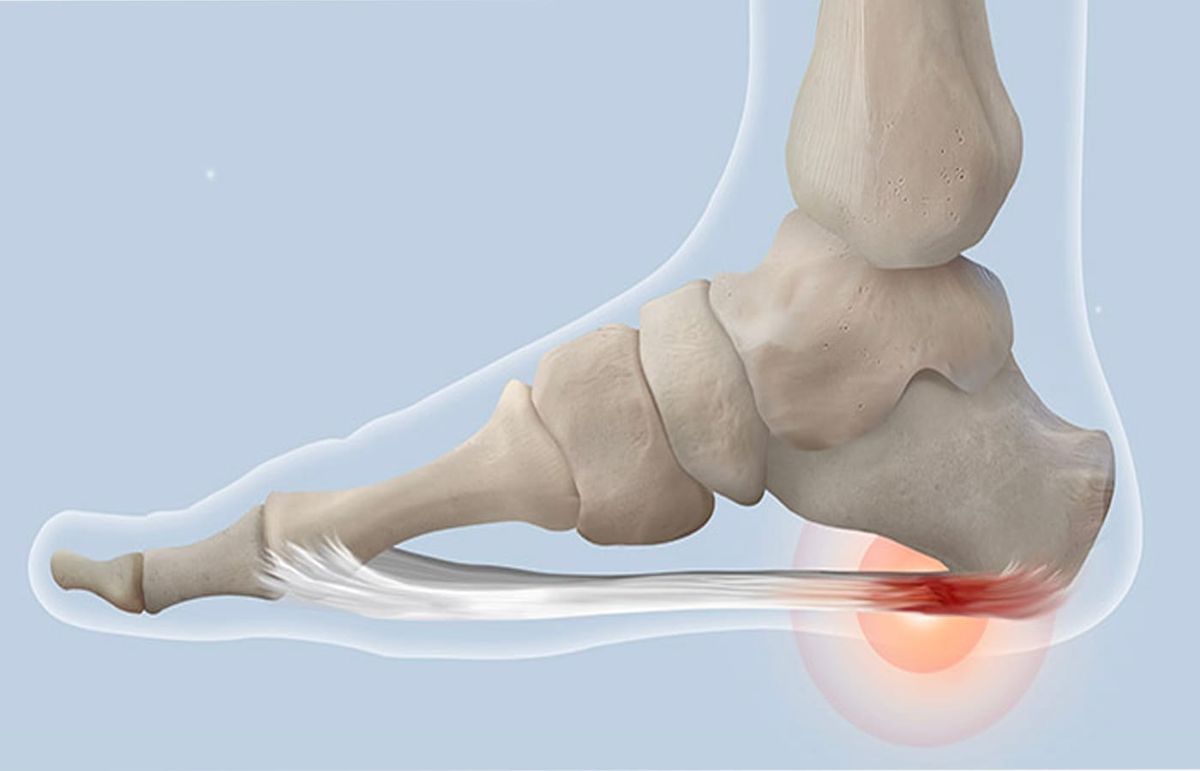 Plantar Fasciitis 