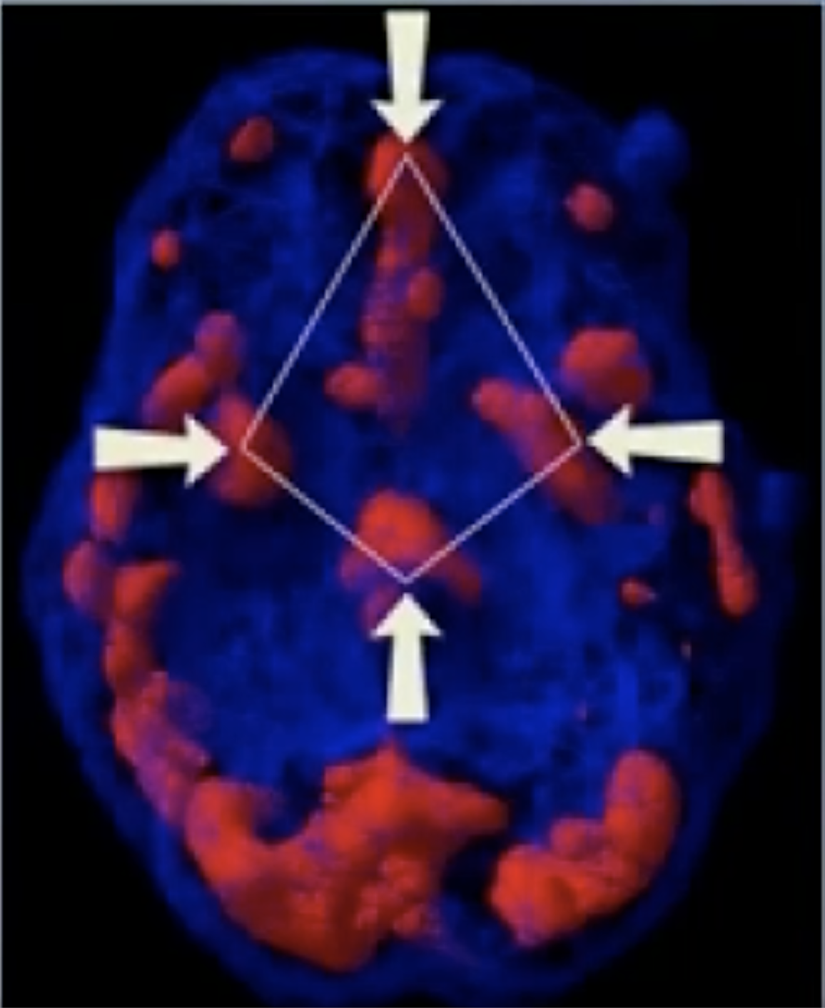When Your Brain is on Fire: Understanding the “Diamond Pattern” of PTSD and Why Talk Therapy Isn’t Enough