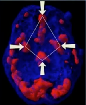 When Your Brain is on Fire: Understanding the “Diamond Pattern” of PTSD and Why Talk Therapy Isn’t Enough