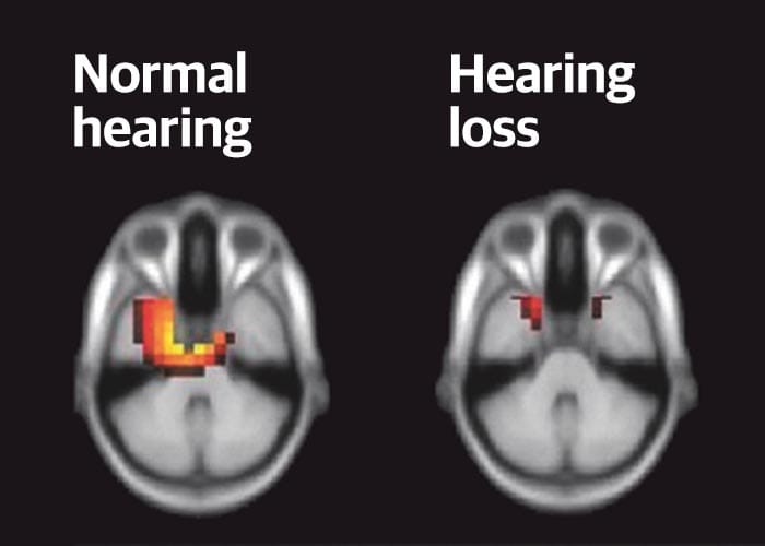Hearing loss and Dementia — the verdict is in