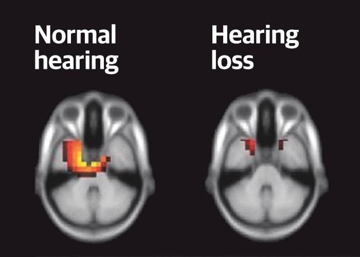 Hearing loss and Dementia — the verdict is in post image