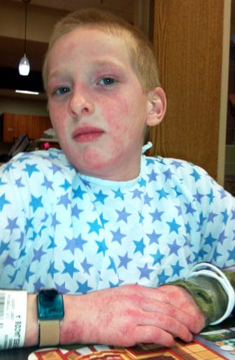 Jacob Reeves is shown in the hospital while being treated for the extremely rare disease juvenile dermatomyositis in 2014. During his treatment he received heavy doses of steroids, as well as an immunoglobulin treatment called "IgG" which combines antibodies (immunoglobulin G) from 1000 different donors.