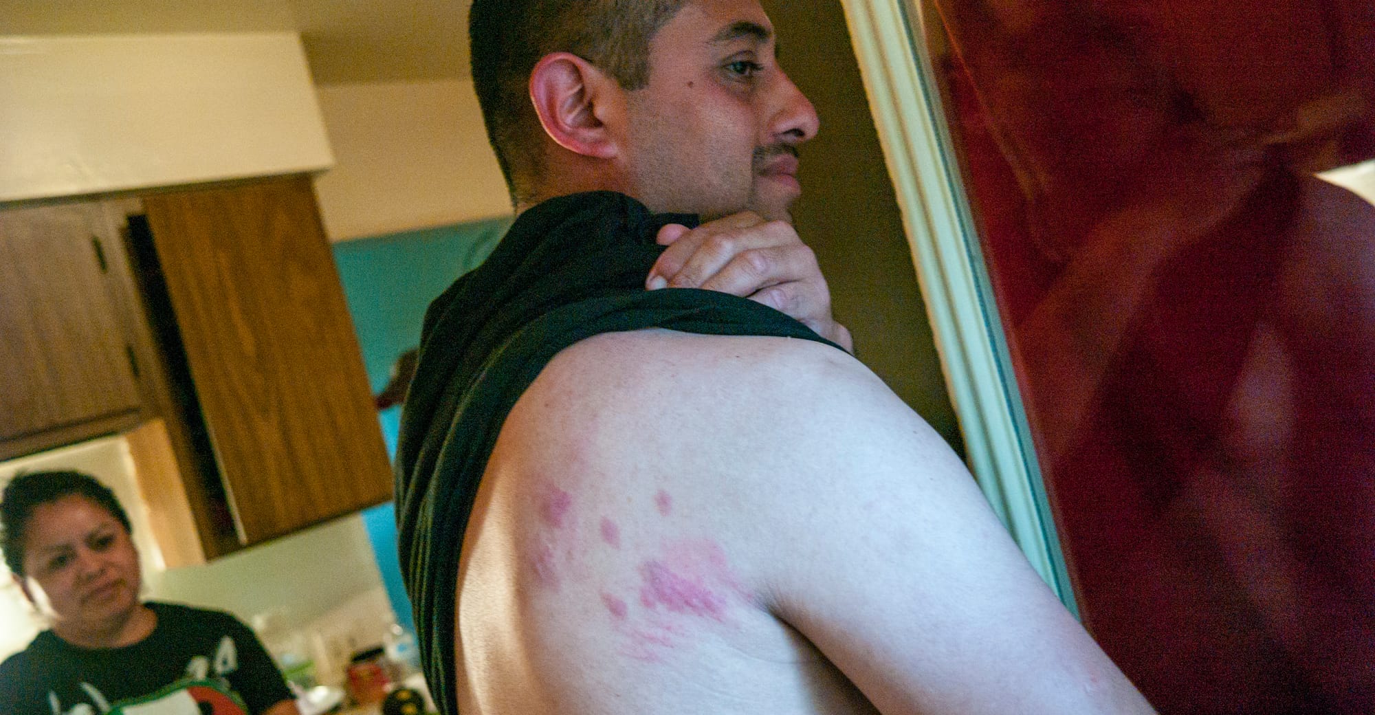 Jose Veja, a 36-year-old from Texas living at the Pine Creek housing facility, pulls up his shirt to show a back covered in beg-bug bites on June 16, 2016.