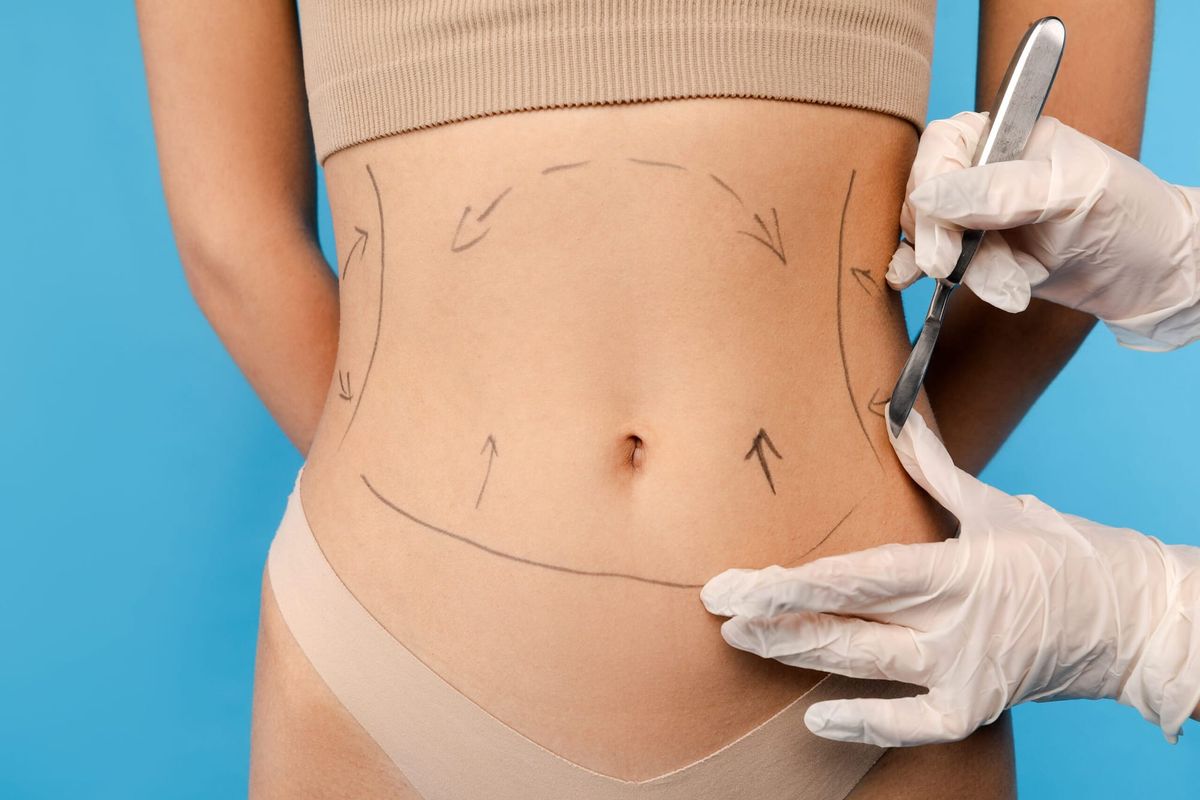 Am I a Good Candidate for Liposuction?