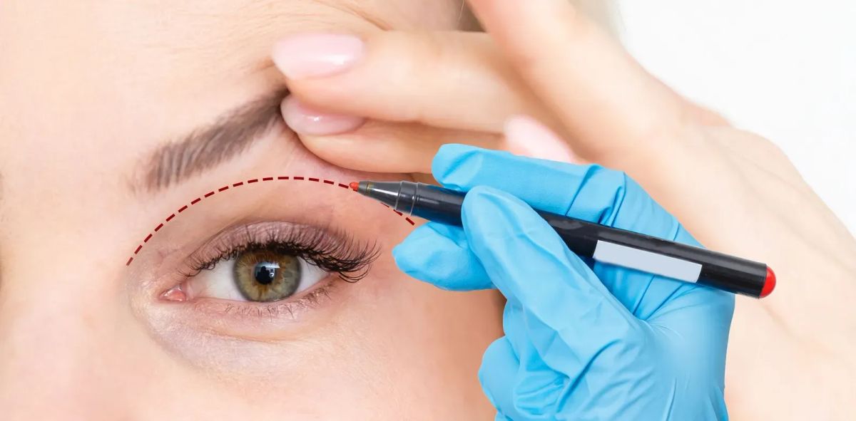 Am I a Good Candidate for Eyelid Surgery (Blepharoplasty)?