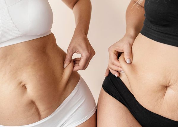 What Is a Mini Tummy Tuck?