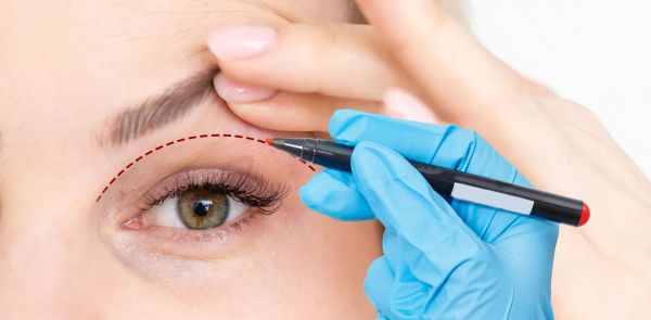 Am I a Good Candidate for Eyelid Surgery (Blepharoplasty)?