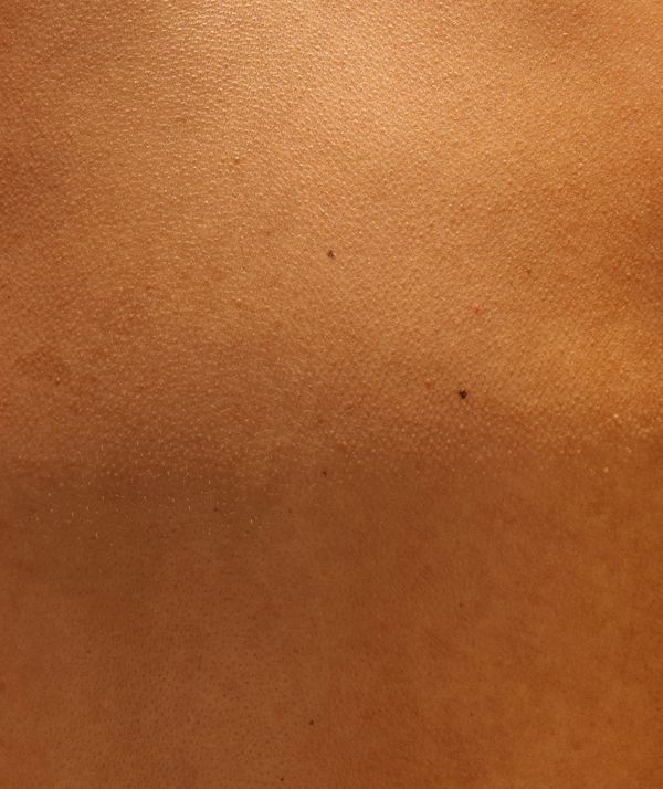 Skin Tightening Cost in Los Angeles (2025 Guide)