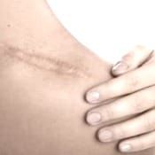 A scar on skin left by a blade