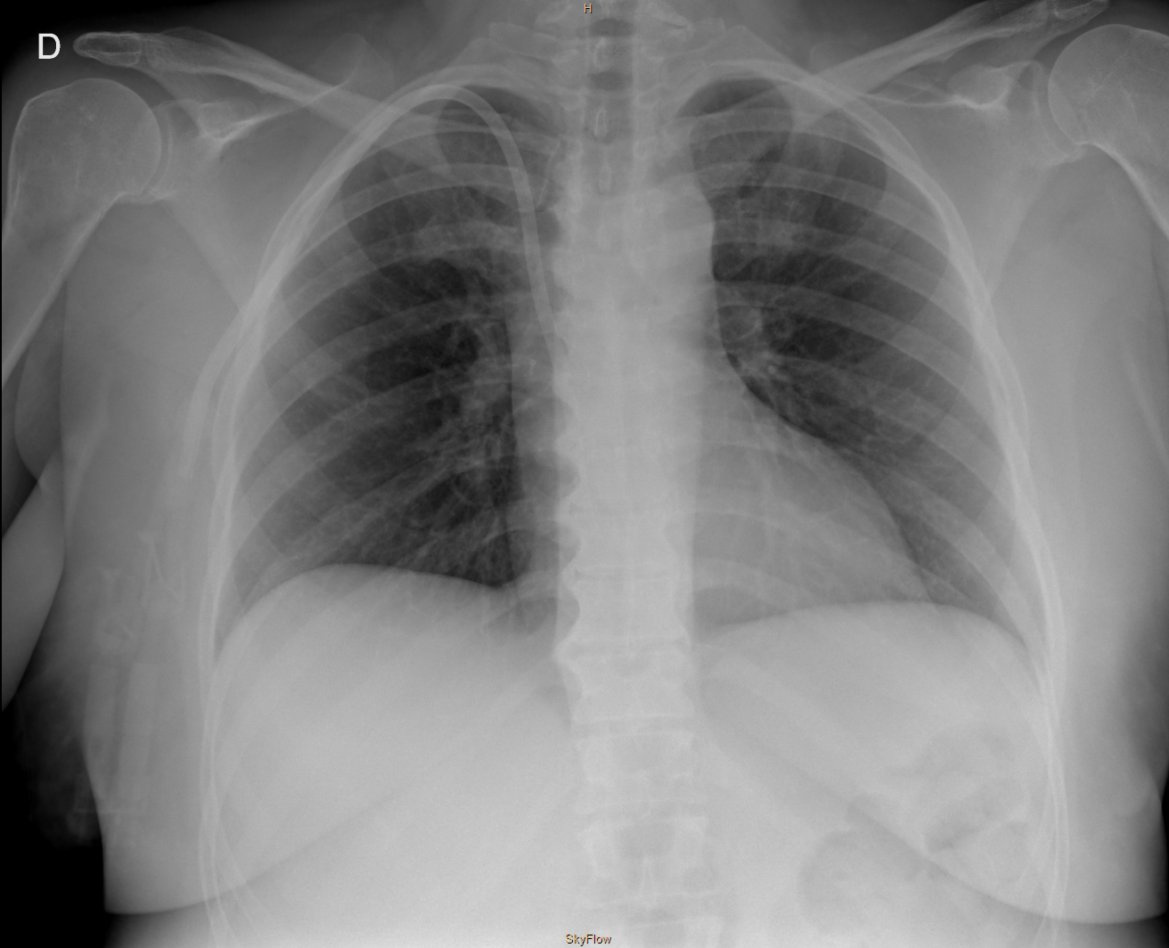 Radiografía de tórax posteroanterior con catéter yugular tunelizado derecho normoposicionado