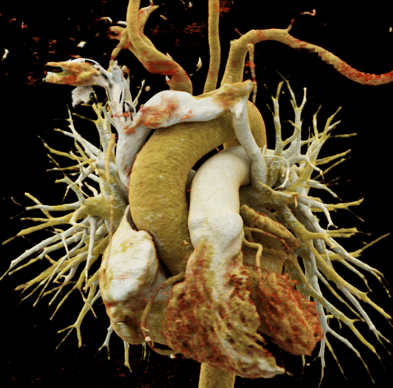 Reconstrucción 3D de TC torácico con vena cava superior izquierda persistente que drena en la aurícula izquierda