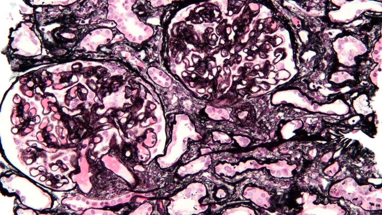 Micrografía de una biopsia renal con nefropatía membranosa, tinción de plata metenamina (PAS-metenamina): dos glomérulos con las membranas basales engrosadas