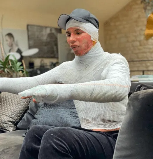 Balmain Designer Olivier Rousteing Shares Moving Story Behind His Burns Recovery