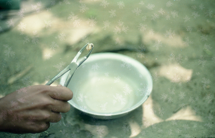 a hand holds dental pliers gripping a tooth over a bowl