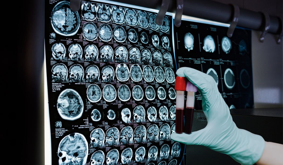 Alzheimer's blood test