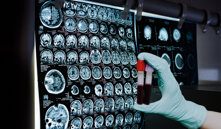 Alzheimer's blood test