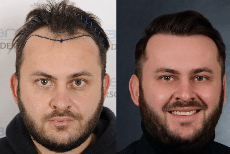 Patienten profitieren von den günstigen Preisen für eine Haartransplantation in der Türkei.
