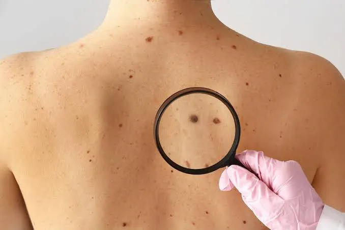 Half a million Australians have common skin cancers removed each year