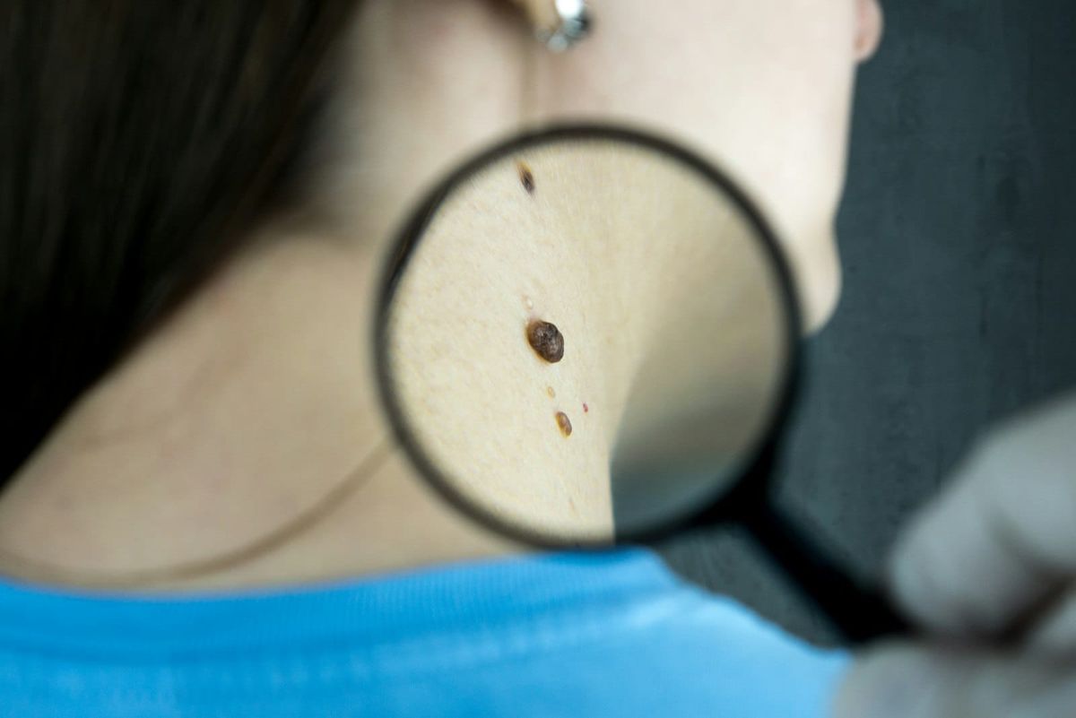 A clinician holds a magnifying glass over a mole on a patient's neck