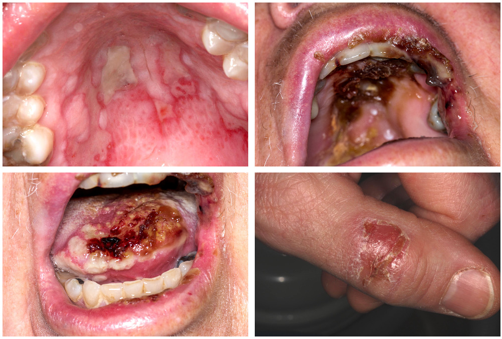 Pictures showing erythema multiforme changes in mouth and on the back of a finger