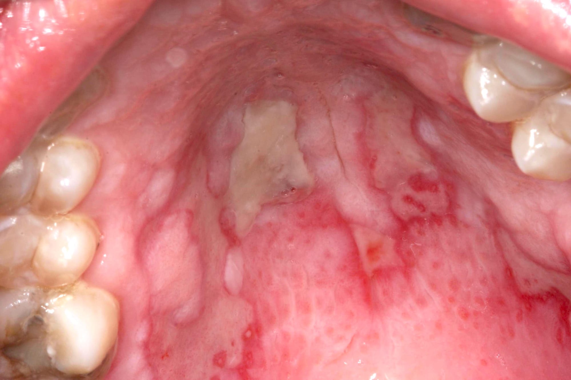 Erythema multiforme i gommen med rodnade områden och ulcerationer
