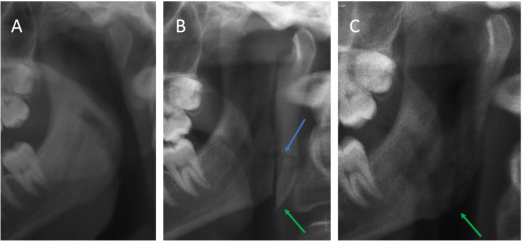 Röntgenbilder av käkled före (A), direkt efter (B) och efter läkning (C) vid modifierad kondylotomi; osteotomilinje och kondylförskjutning markerade med pilar
