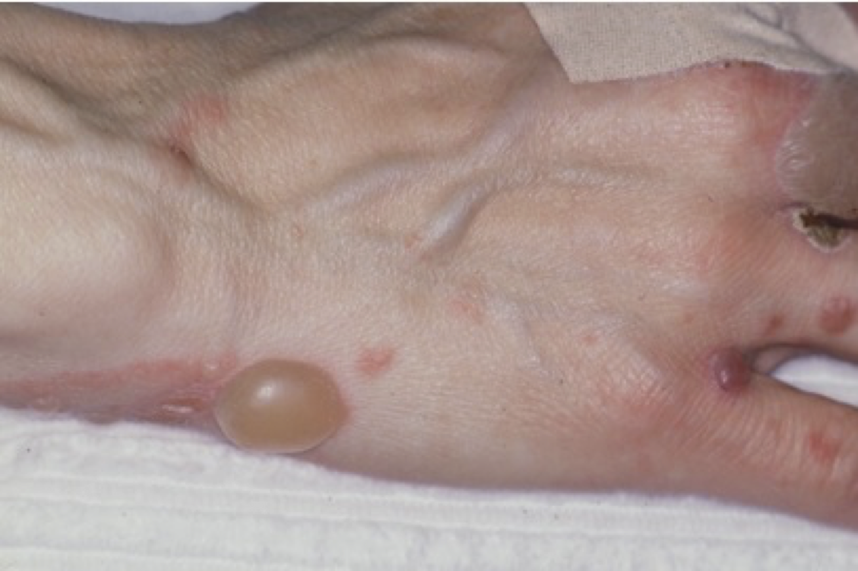 Stor vätskefylld blåsa på handen vid bullös pemfigoid