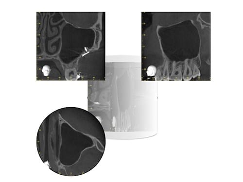 CBCT-tvärsnittsbilder från olika vinklar inom käkregionen