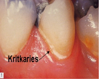 Kritkaries vid tandköttskanten – initial emaljskada synlig som vit fläck