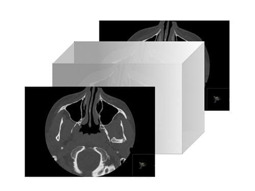 Konventionell datortomografi jämfört med CBCT-data i tandvården