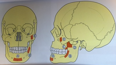 Illustration av kraniet som visar möjliga donatorområden för benrekonstruktion i käkregionen