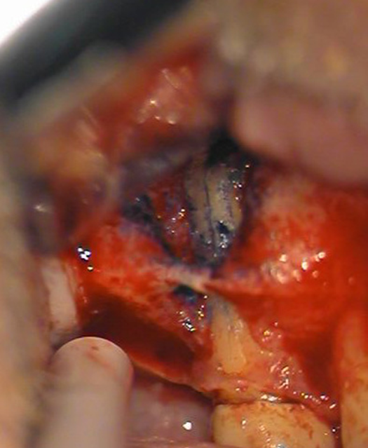 Närbild på kirurgiskt ingrepp vid apikoektomi med synlig rotrest