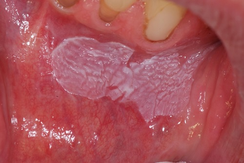 Homogen leukoplaki i kindens slemhinna med tydligt avgränsad vit lesion
