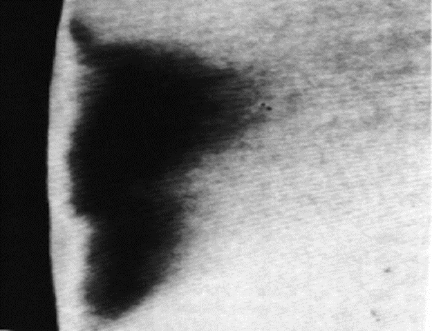 Röntgenbild av avancerad karies – typisk triangulär spridning mot pulpan