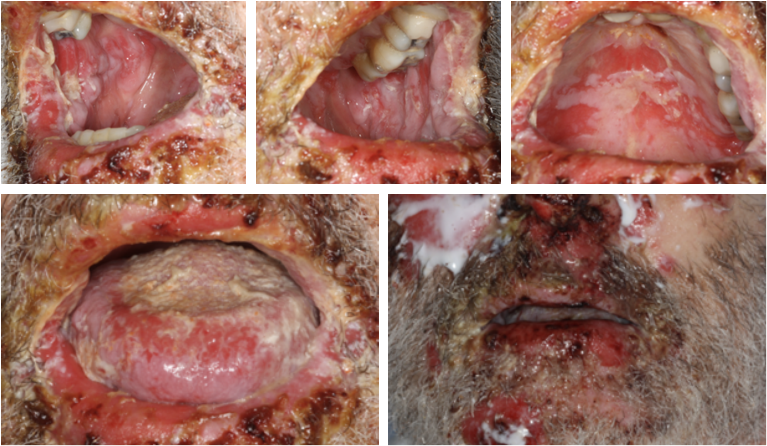 Kliniska bilder av toxisk epidermal nekrolys (TEN) med svåra lesioner i munhåla och ansikte