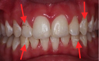 Flera kritkariesfläckar på över- och underkäkens framtänder – tidigt tecken på karies